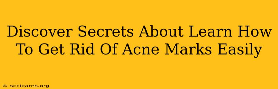 Discover Secrets About Learn How To Get Rid Of Acne Marks Easily